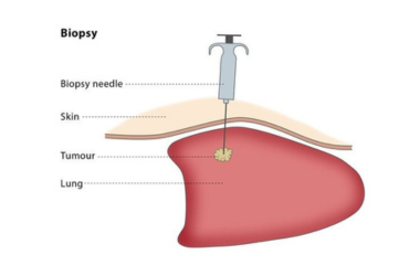 Lung Biopsy