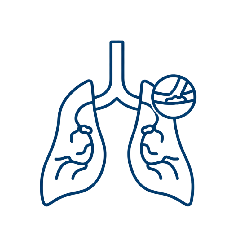 Sarcoidosis treatment and management